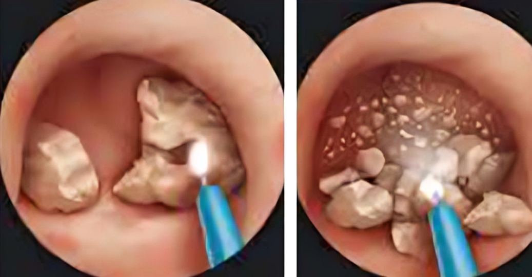 अत्तरिया हस्पिटलमा लेजर प्रविधिबाट मिर्गौला पत्थरीको उपचार गरिने