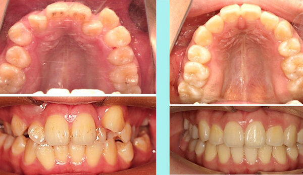 दाँत सम्बन्धी तथ्य र भ्रमहरू