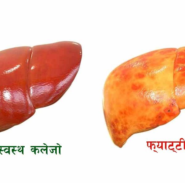 फ्याटी लिभरको समस्यालाई कसरी नियन्त्रण गर्ने ?